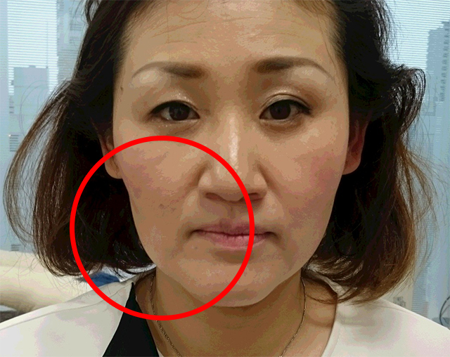 講師をモデルとし、半顔を施術