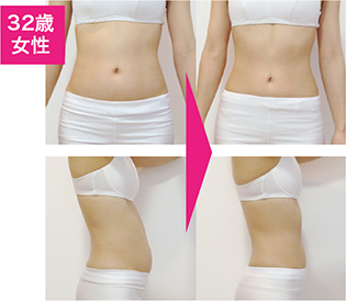 脂肪冷却痩身の効果をチェック！