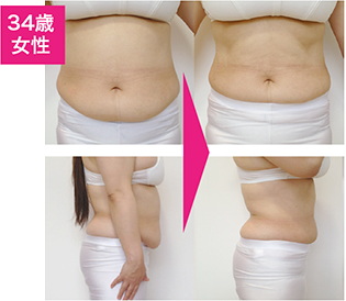 脂肪冷却痩身の効果をチェック！